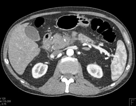 For evaluating possible pancreatic cancer, a multiphase helical ct scan or pancreatic protocol ct scan is often recommended. Pancreatic Cancer with Superior Mesenteric Artery (SMA ...