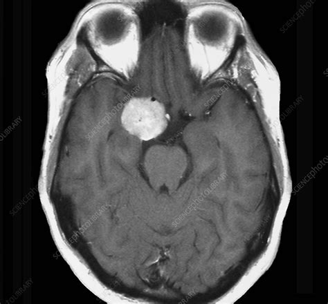 Meningioma Brain Tumour Mri Scan Stock Image C0472761 Science