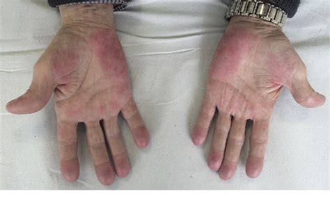 Figure 1 From Hand Foot Skin Reaction To Regorafenib Reacción Cutánea