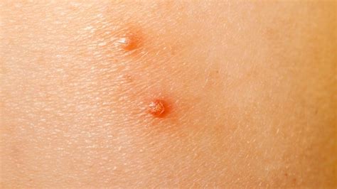 molluscum contagiosum symptoms causes and treatment toronto dermatology centre