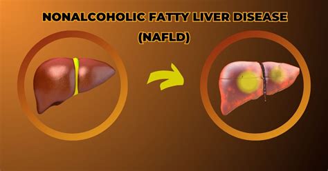 Understanding Nafld And Nash Causes Symptoms Treatment And Prevention