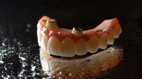 Permanent Dentures Ottawa Non Removable Fixed Dentures