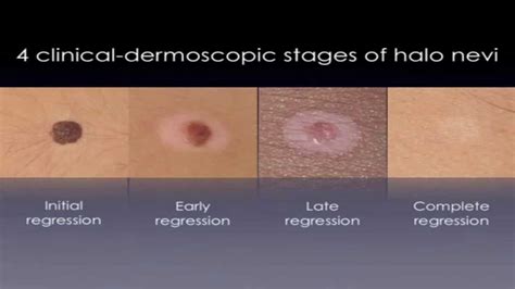 Halo Nevus White Circles On Skin Treatment Youtube