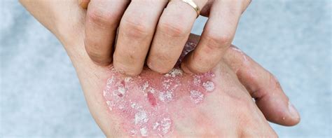 Identifying Your Rash Most Common Rash Types