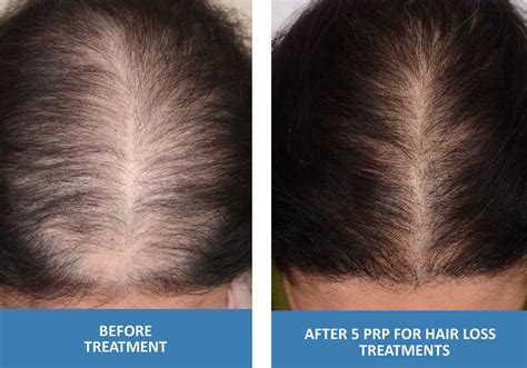 Prp For Hair Loss Platelet Rich Plasma In Springfield Missouri