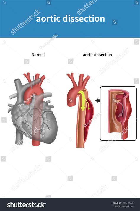 Medical Illustration Explain Aortic Dissection Stock Illustration