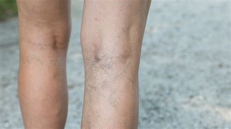 Deep Vein Thrombosis Early Symptoms Signs Causes Treatments My Xxx