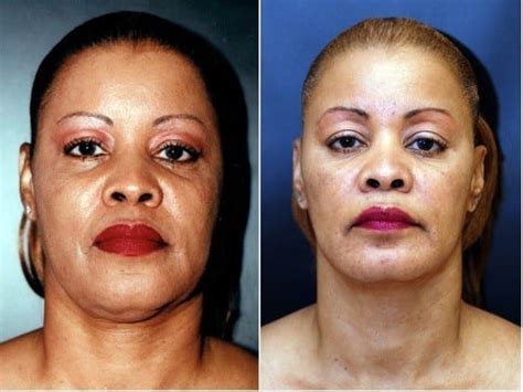 Neck Lift With Liposuction And Suspension Dean P Kane Md Facs