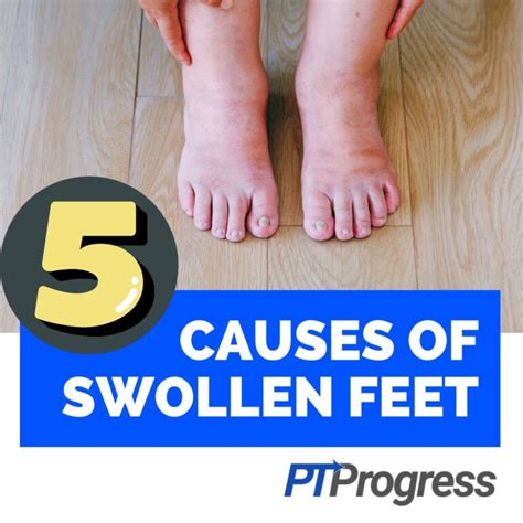5 Causes You Have Swollen Toes And Ankles My Blog
