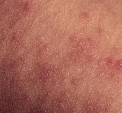 What Is Pityriasis Lichenoides Chronica With Pictures