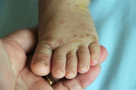 9 Infeksi Dan Penyakit Kulit Pada Anak Yang Umum Terjadi Wajib Tahu