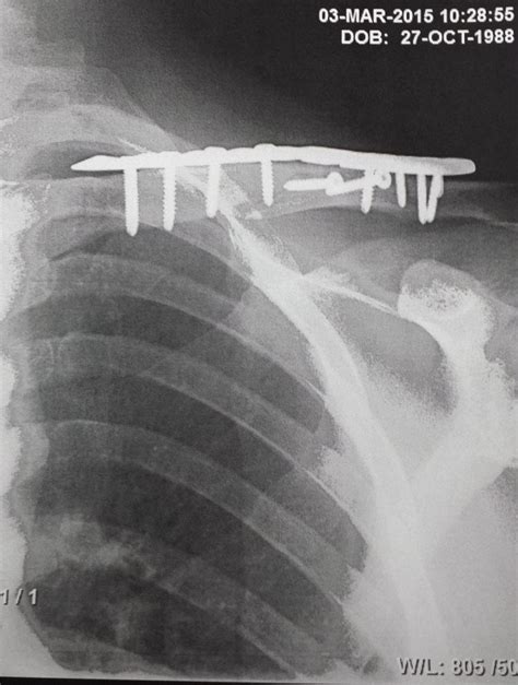 Broken Clavicle Surgery Plate And Screws What Would You Do