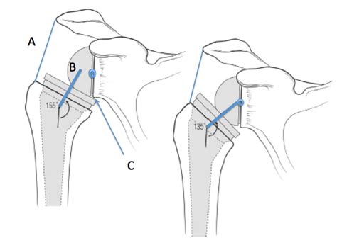 Uw Shoulder And Elbow Academy Reverse Total Shoulder Arthroplasty