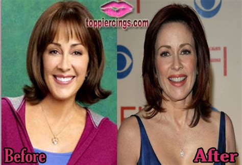 Patricia Heaton Plastic Surgery Before And After Top Piercings