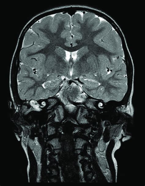 T2 Weighted Magnetic Resonance Imaging Mri Of The Brain Shows The