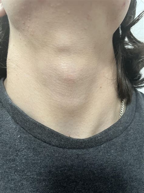 does anyone know what this lump above my adam s apple could possibly be i m guessing it s a