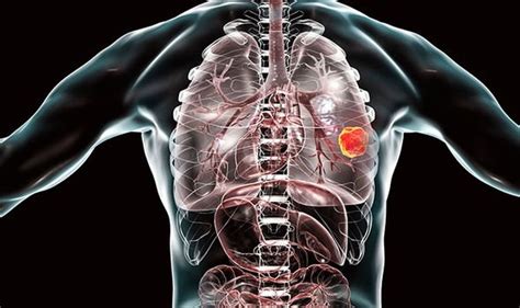 Lung Cancer Symptoms Signs Of Tumour Include Breath Noise Uk