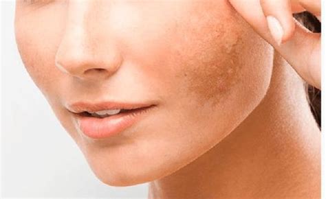 Hyperpigmentation Guide Treatments Types Causes And Preventions Fabbon