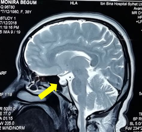 2 Empty Sella Turcica On Mri Brain Download Scientific Diagram