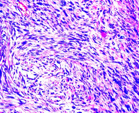 Pathology Outlines Leiomyosarcoma General