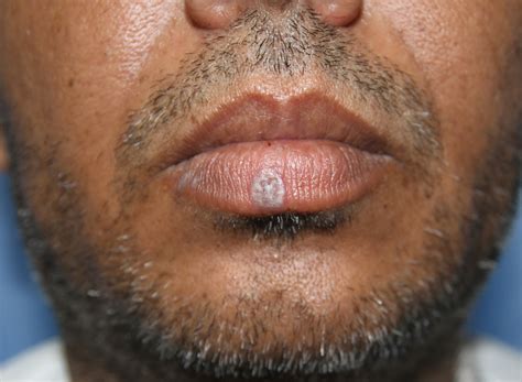 Isolated Lichen Planus Of Lip Diagnosis And Treatment Monitoring Using