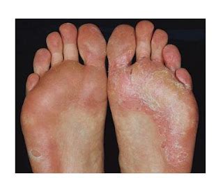 Tinea Pids Athlete S Foot Symptoms Treatment And Prevention
