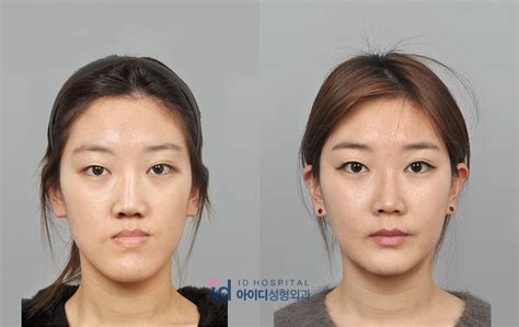 Id美容外科。 両顎手術（ルフォー） 情報、両顎手術（ルフォー）ビフォーアフター 韓国での美容整形は韓国id美容外科・韓国美容整形両顎