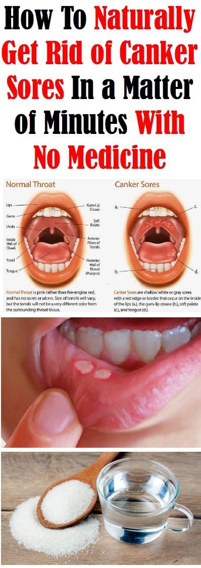What is the difference between canker sore vs. HOW TO NATURALLY GET RID OF CANKER SORES IN MINUTES WITH ...
