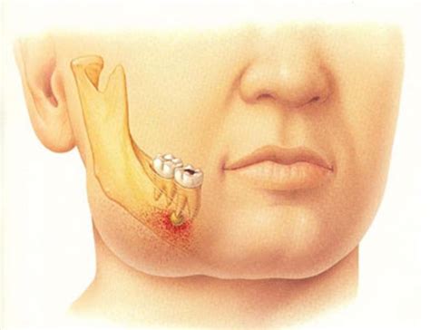 Dan semestinya kos agak mahal bersebelahan kanan dan kiri gigi yang nak diganti tu. Nak Pitam Menghadap Orang Yang Mulut Busuk, Gigi Kuning ...