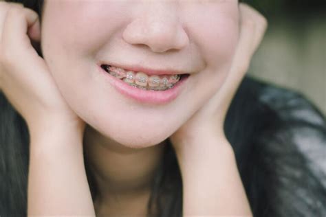 Get To Know The Different Types Of Braces Available Somos Dental