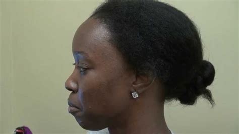 Come see actual hair transplant 'before' & 'after' photo examples from people here in the san francisco bay area and san jose area. Black Woman Hair Loss Transplant Before and After Dr. Diep ...