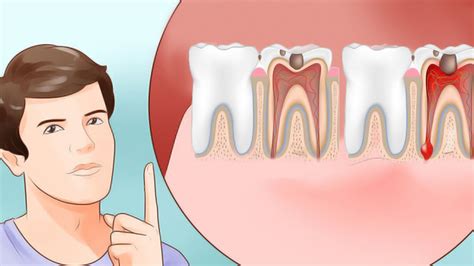As a result, a chemical reaction occurs inside the structure of the bone. 6 Home Remedies for Toothache That Really Work - YouTube