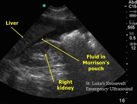 Pouch of douglas hernias are uncommon forms of pelvic hernia. Intra-abdominal Fluid - Sonography | Medicína, nemoci ...
