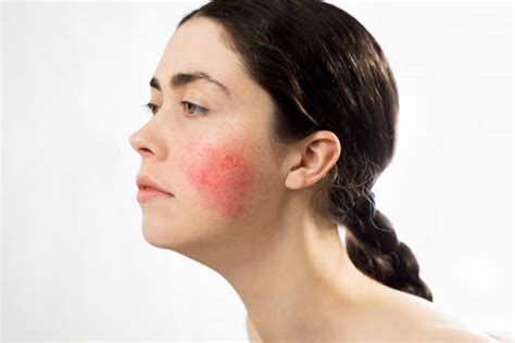 Rosacea Stock Photos Pictures And Royalty Free Images Istock