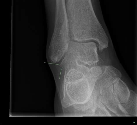 Lateral Talar Process Fracture Pacs