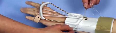 Radial Nerve Palsy Orthosis