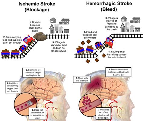 Recovery After A Stroke—five Tips For Rehabilitation · Frontiers For