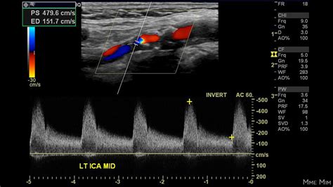 Carotid Artery Stenosis Chart Ultrasound