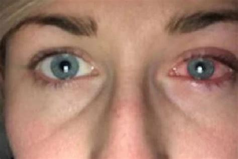 I Almost Went Blind After A Parasite Bore Into My Eye After Swimming In Contact Lenses The