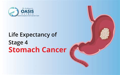 Stage 4 Stomach Cancer Life Expectancy With Treatment Oasis Clinic