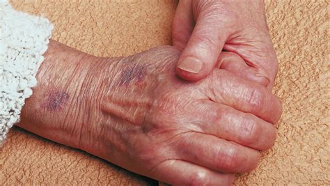 Aging Skin Bruises More Easily