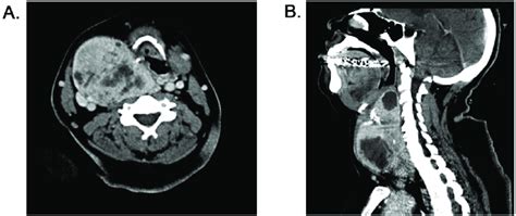 A Axial Ct Neck With Contrast Of Case 2 The Retropharyngeal