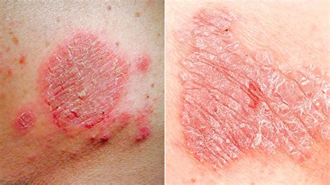 Seborrheás Dermatitis Versus Pikkelysömör Sanidex Magyarországon