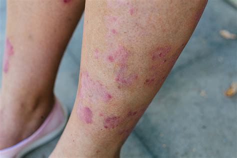 Itchy Lower Legs Ankles Causes Rash And