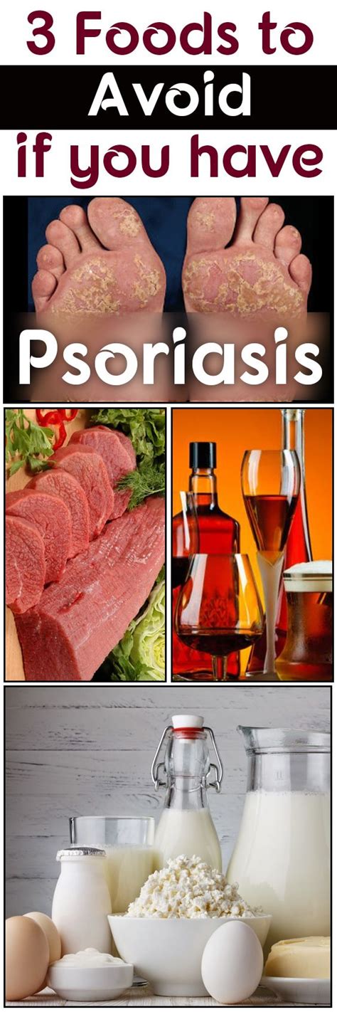 3 Foods To Avoid If You Have Psoriasis Foods For Healthy Skin Foods