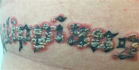 Literature Update Tattoos And Psoriasis The Dermatology Digest