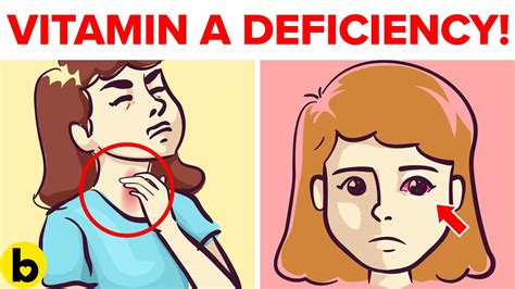 5 hidden signs of vitamin a deficiency you should not ignore youtube