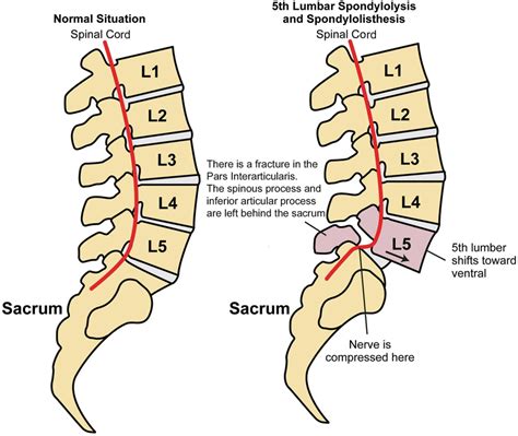 Chapter 8 Spine I Structured Sba Musculoskeletal Key