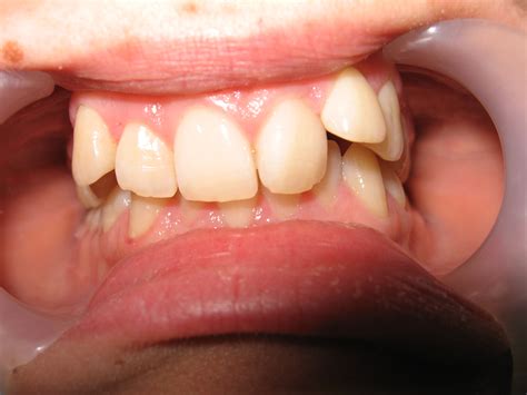 Ortodontie Estetica Dentara Tratament Ortodontic Invizibil Invisalign