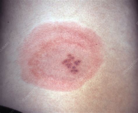 Herpes rash dermatitis is a condition of inflamed skin. Shingles rash - Stock Image - M260/0251 - Science Photo ...